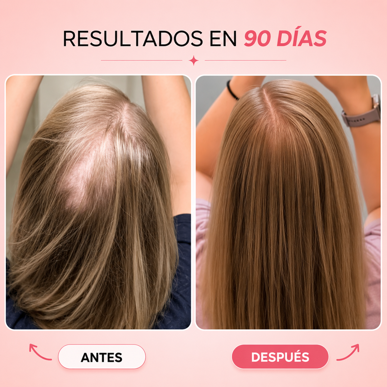 Kiesu — Tratamiento LED para Recuperar la Densidad y Frenar la Caída