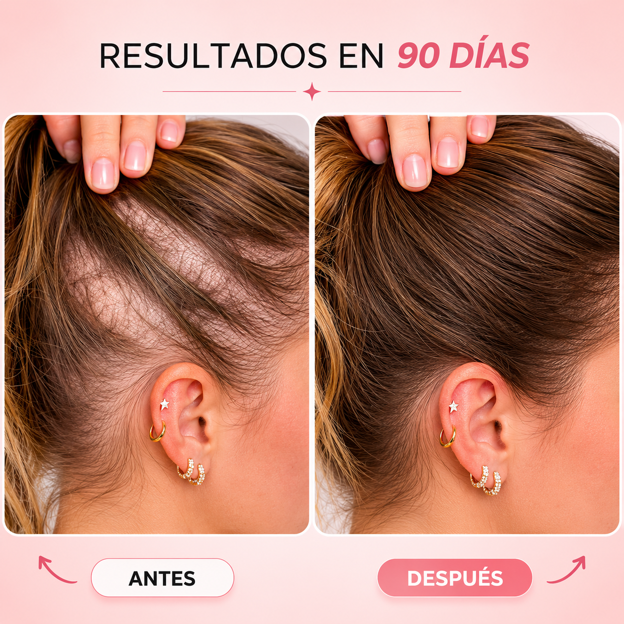 Kiesu — Tratamiento LED para Recuperar la Densidad y Frenar la Caída
